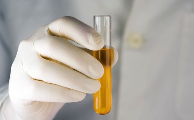 Một mẫu nước tiểu nên được thu thập để phân tích nước tiểu và cấy nước tiểu